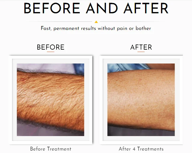 HAIR REMOVAL GALLERY