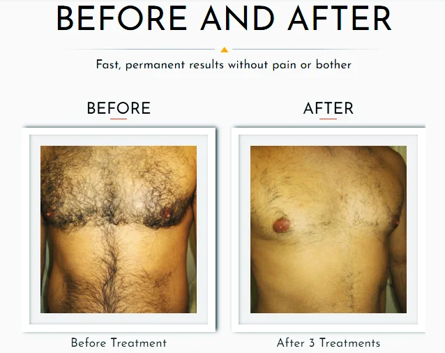 HAIR REMOVAL GALLERY