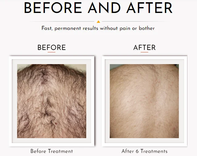 HAIR REMOVAL GALLERY