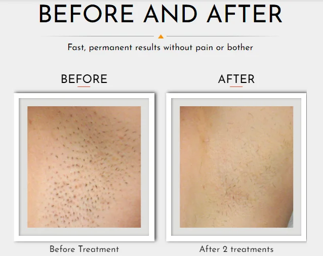 HAIR REMOVAL GALLERY